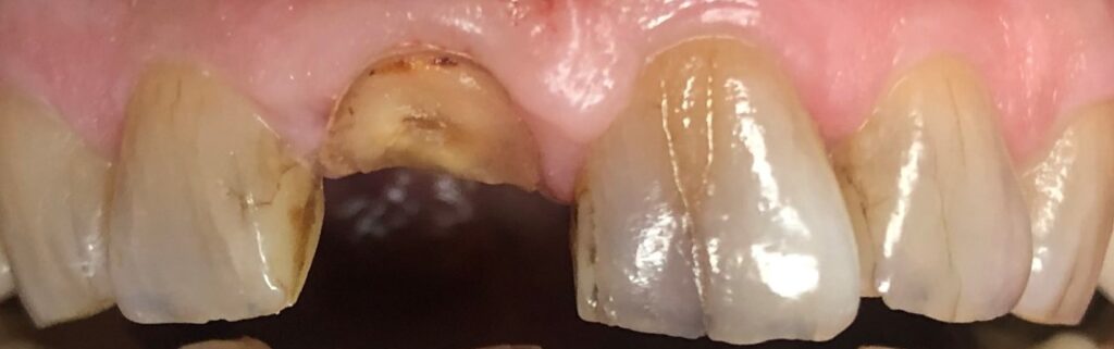 Close-up of decayed front tooth with visible enamel damage.
