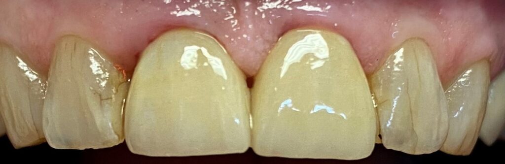 Close-up of yellowed teeth showing surface stains and gum line.
