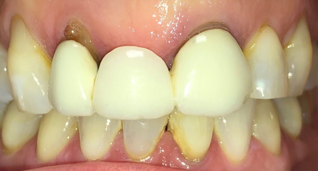 Close-up of stained teeth showing discoloration near gums and enamel