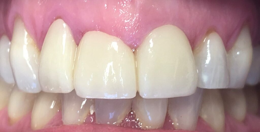 Close-up of human teeth showing upper and lower dental alignment