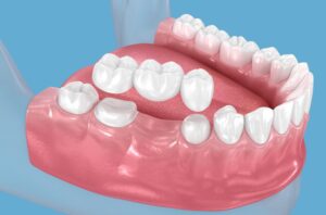 Dental Bridges Clinton Township