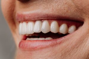 Dental Veneers Clinton Township